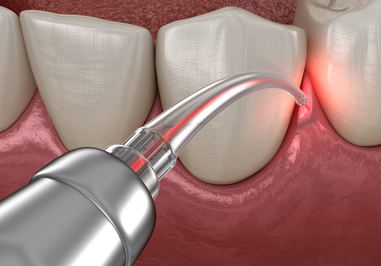 Aesthetic Gum Correction