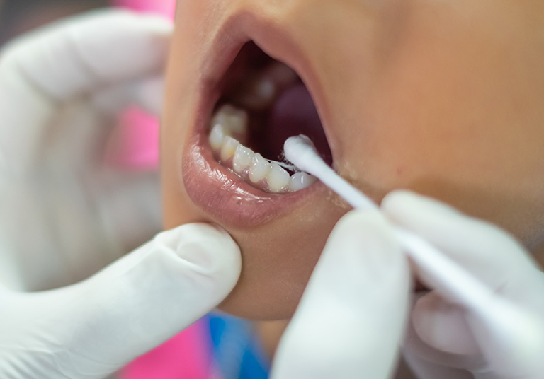 Fluoride Treatments