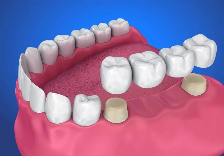 Full Porcelain Crowns and Bridges