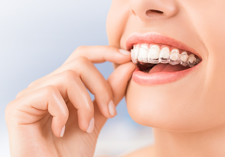 Invisalign