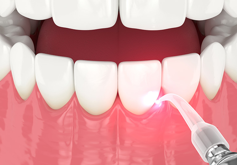 Laser Peridontal Gum Treatment