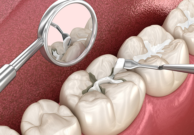 Pit & Fissure Sealants
