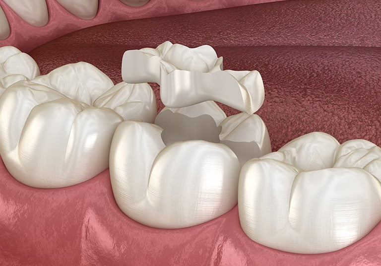 Porcelain Inlays/Onlays