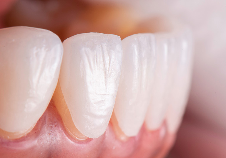 Porcelain Veneers