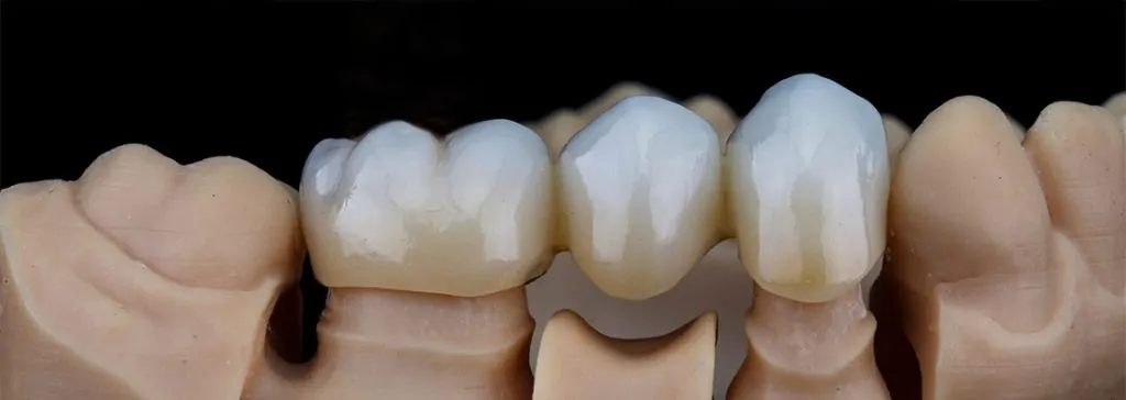 Porcelain crowns