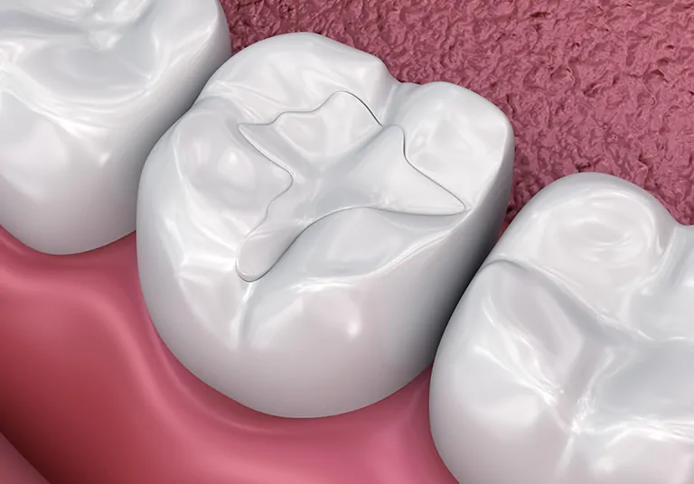 Restorative Fillings