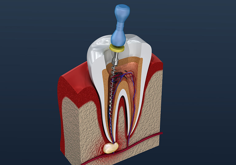 Root Canal Treatment