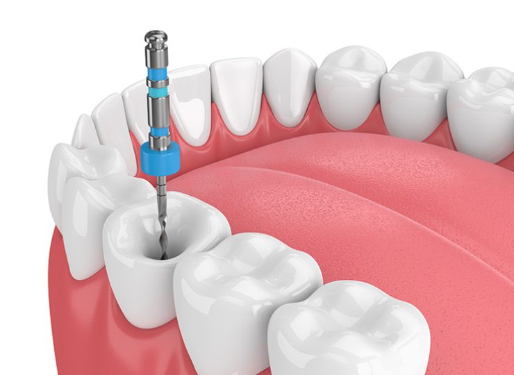 Root Canal Treatment (RCT)