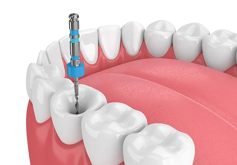 Root Canal Treatment (RCT)