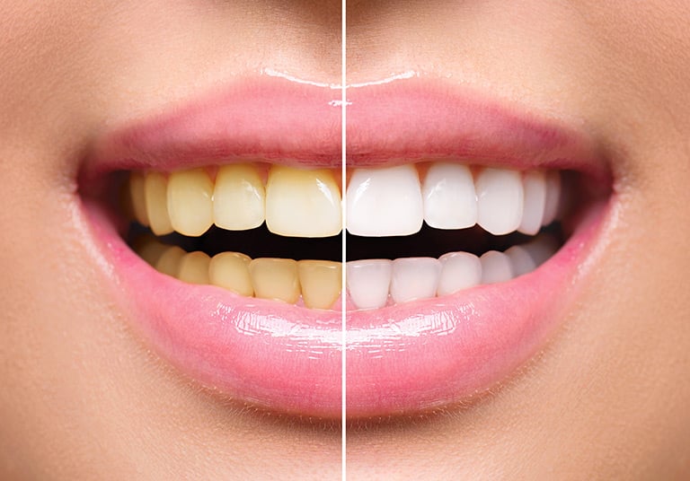 Teeth Whitening with Zoom Advanced Power Whitening