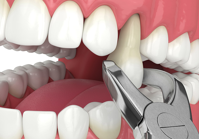 Tooth Extraction