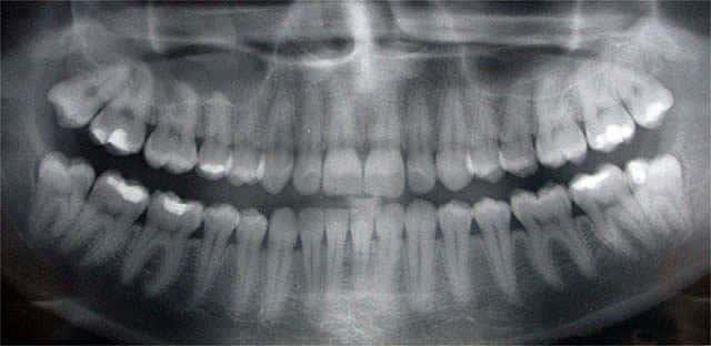 Digital X-ray