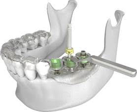 Implant Surgical Template Guide