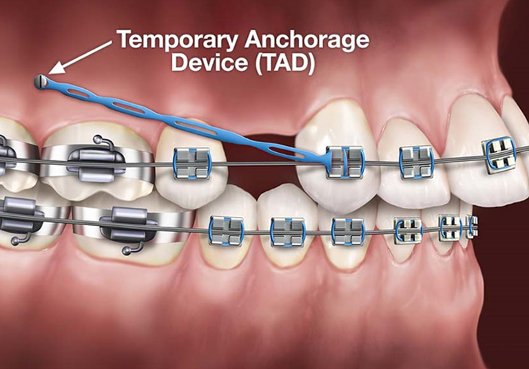 Braces with TADS