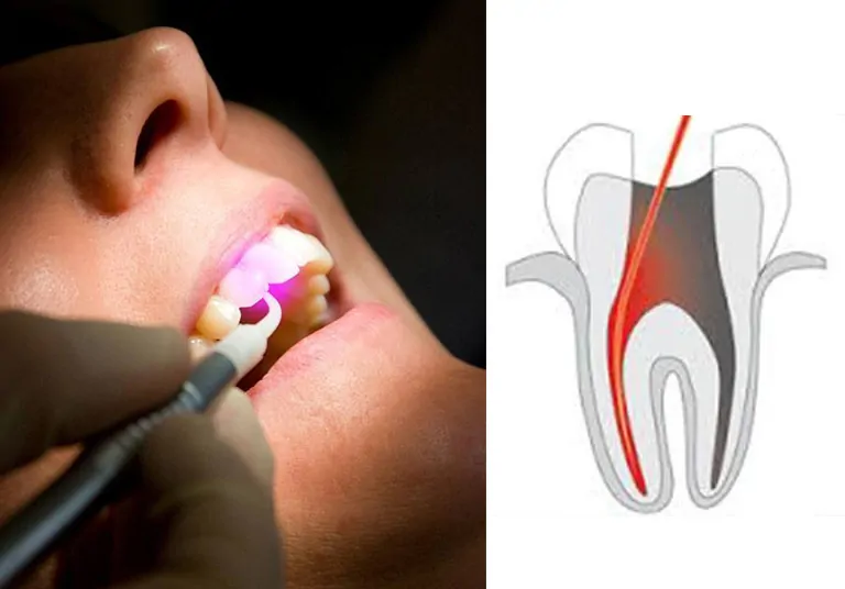 Laser Root Canal Disinfection