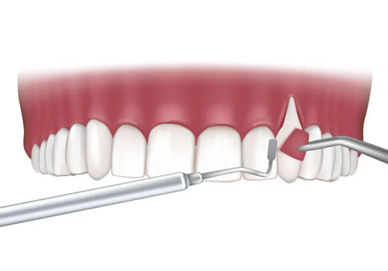 Soft Tissue Grafting