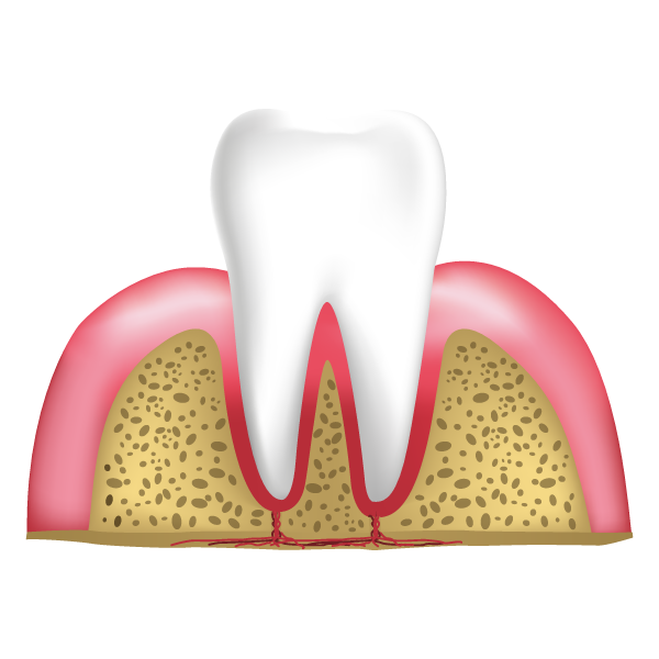 Stage One - Gingivitis