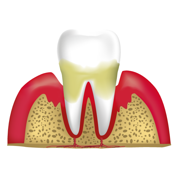 Stage Three - Moderate Periodontal Disease