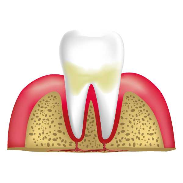 Stage Two - Slight Periodontal Disease