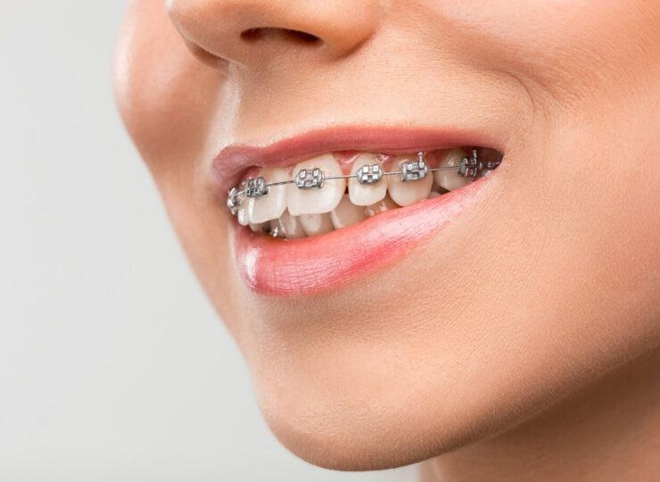 Early Intervention, Lifelong Benefits: Exploring the World of Interceptive Orthodontics!