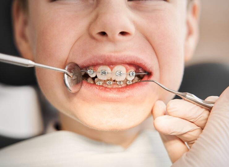 Positive,smiley,little,boy,having,his,braces,checked.,close Up,portrait