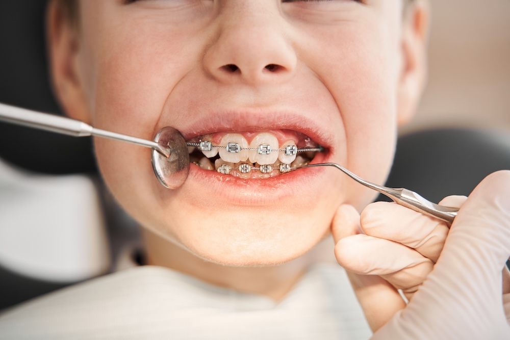 Positive,smiley,little,boy,having,his,braces,checked.,close Up,portrait