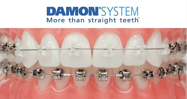 Damon Braces